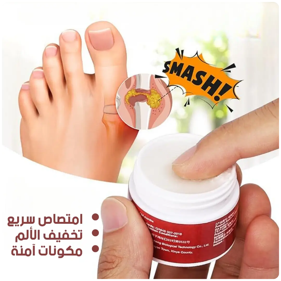 Urigone Healing Ointment for Gout – العلاج الطبيعي والفعّال لألم النقرس والتورم